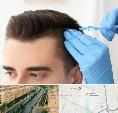 مزوتراپی مو در فاز سه اندیشه