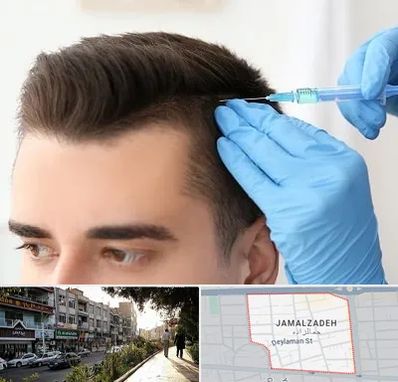 مزوتراپی مو در خیابان جمالزاده