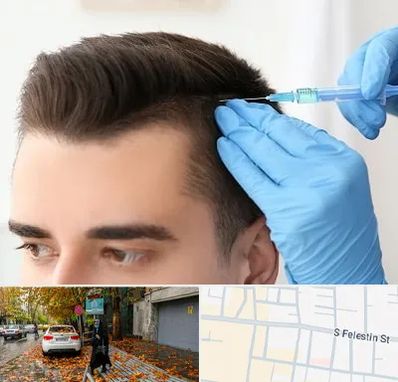 مزوتراپی مو در خیابان فلسطین