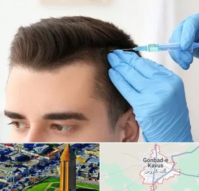 مزوتراپی مو در گنبد کاووس
