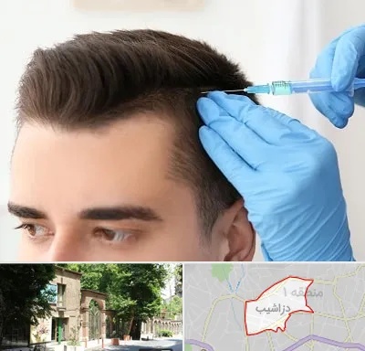 مزوتراپی مو در دزاشیب