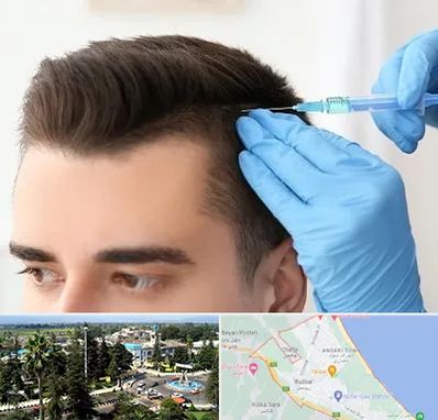 مزوتراپی مو در رودسر