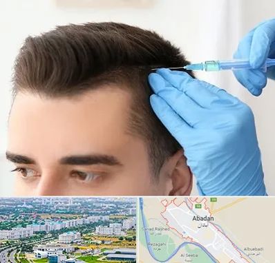 مزوتراپی مو در آبادان