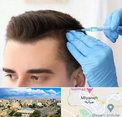 مزوتراپی مو در میانه