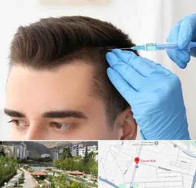 مزوتراپی مو در بلوار تعاون