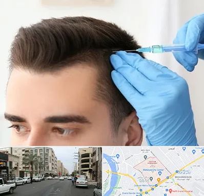 مزوتراپی مو در زیتون کارمندی اهواز