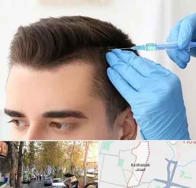 مزوتراپی مو در کاشانک
