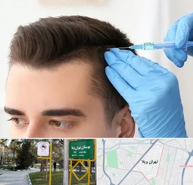 مزوتراپی مو در تهران ویلا