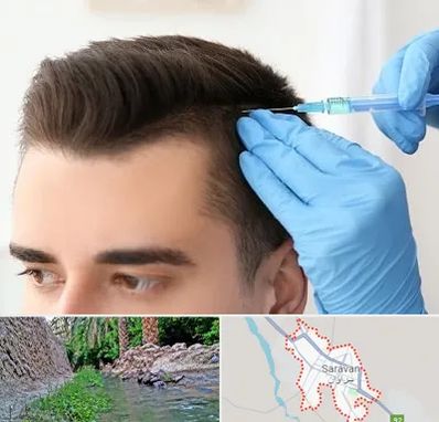 مزوتراپی مو در سراوان