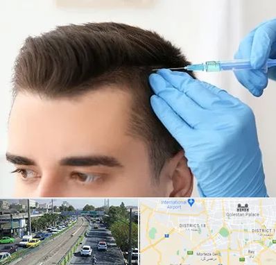 مزوتراپی مو در جنوب تهران