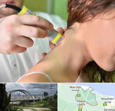 لیزر درمانی در چالوس