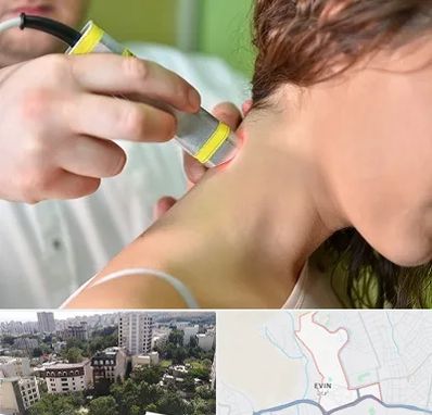 لیزر درمانی در اوین