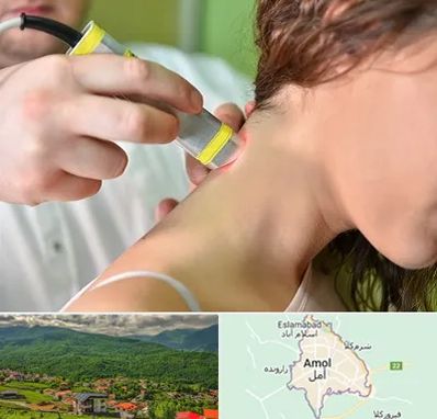 لیزر درمانی در آمل