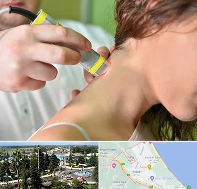 لیزر درمانی در رودسر