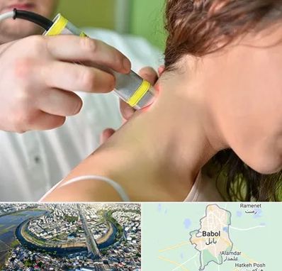 لیزر درمانی در بابل