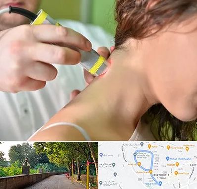 لیزر درمانی در فلکه گاز رشت