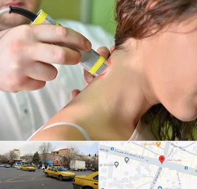 لیزر درمانی در شهناز تبریز