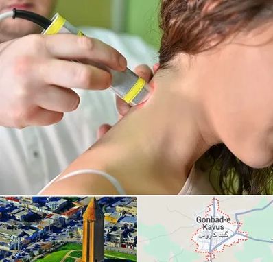 لیزر درمانی در گنبد کاووس