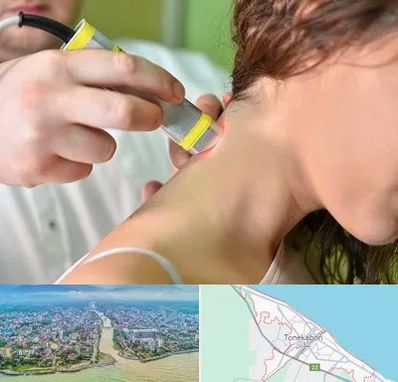 لیزر درمانی در تنکابن