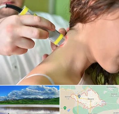 لیزر درمانی در مرند