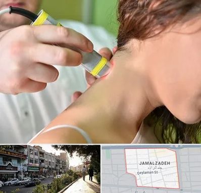 لیزر درمانی در خیابان جمالزاده