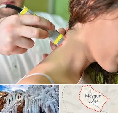 لیزر درمانی در میگون