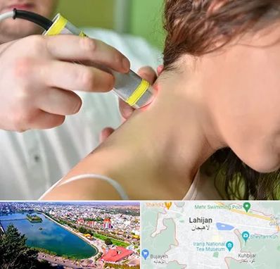 لیزر درمانی در لاهیجان