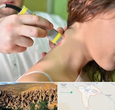 لیزر درمانی در اسکو