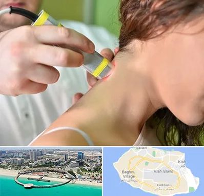 لیزر درمانی در کیش