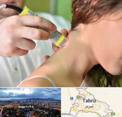 لیزر درمانی در تبریز
