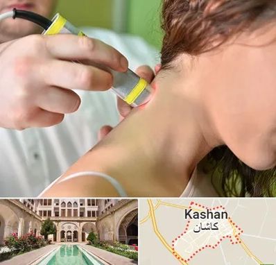 لیزر درمانی در کاشان