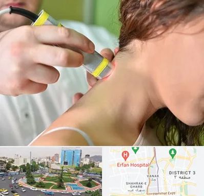 لیزر درمانی در ونک