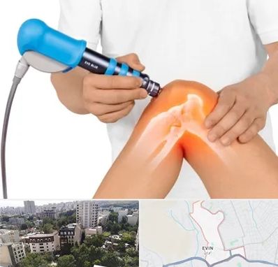 شاک ویو تراپی در اوین