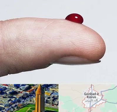 مرکز فصد خون در گنبد کاووس