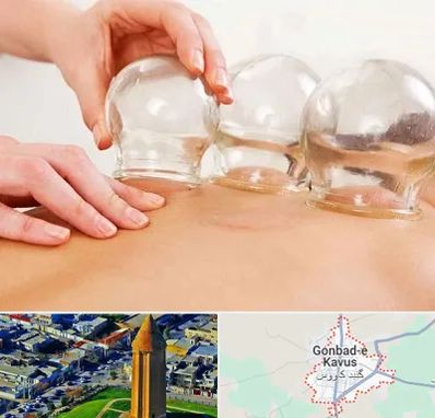بادکش درمانی در گنبد کاووس