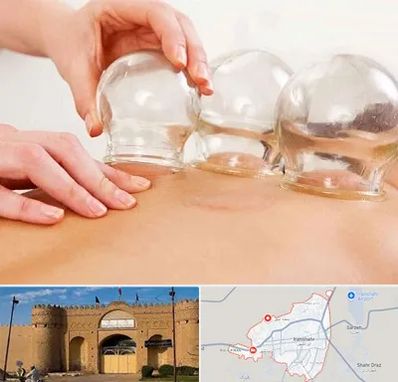 بادکش درمانی در ایرانشهر
