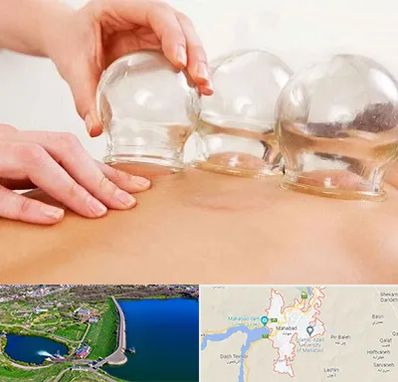 بادکش درمانی در مهاباد