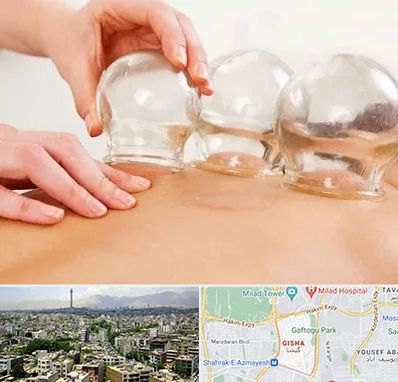 بادکش درمانی در گیشا 