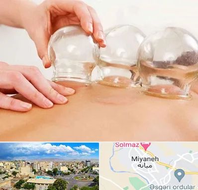 بادکش درمانی در میانه