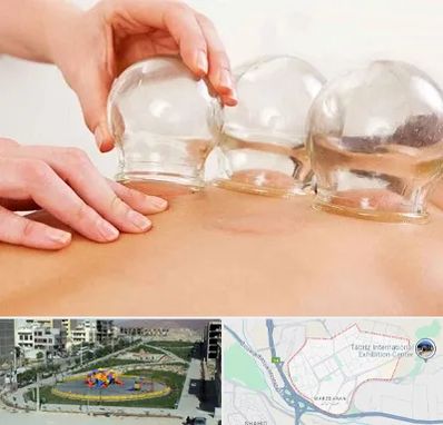 بادکش درمانی در مرزداران تبریز