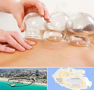 بادکش درمانی در کیش