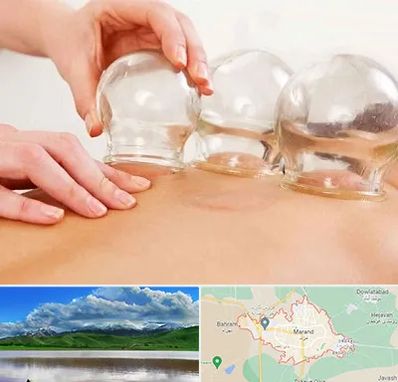 بادکش درمانی در مرند