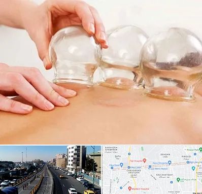 بادکش درمانی در پیروزی 