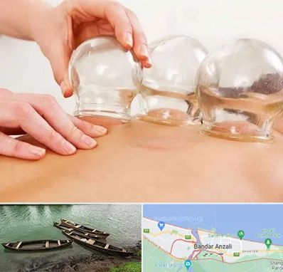 بادکش درمانی در بندر انزلی