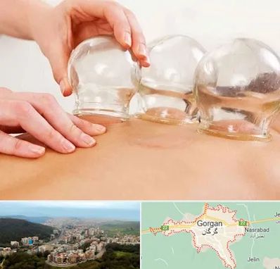 بادکش درمانی در گرگان