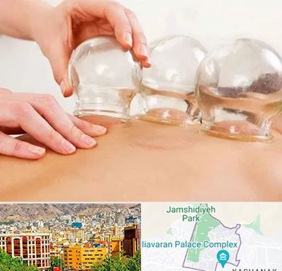 بادکش درمانی در نیاوران 