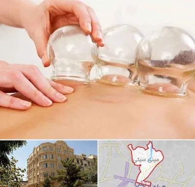 بادکش درمانی در مینی سیتی