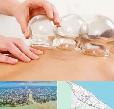 بادکش درمانی در تنکابن