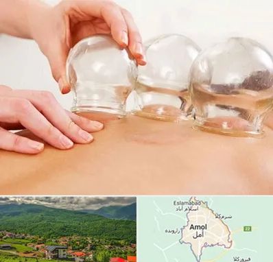 بادکش درمانی در آمل