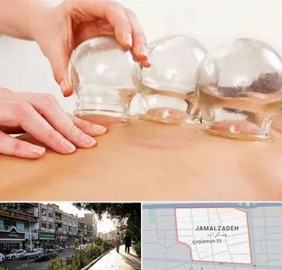 بادکش درمانی در خیابان جمالزاده